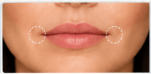 Oral Commissures treatment area