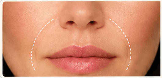 Nasolabial Folds treatment area