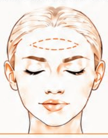 Forehead Lines
