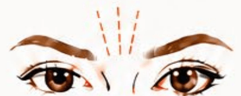 Frown Lines (Glabella)